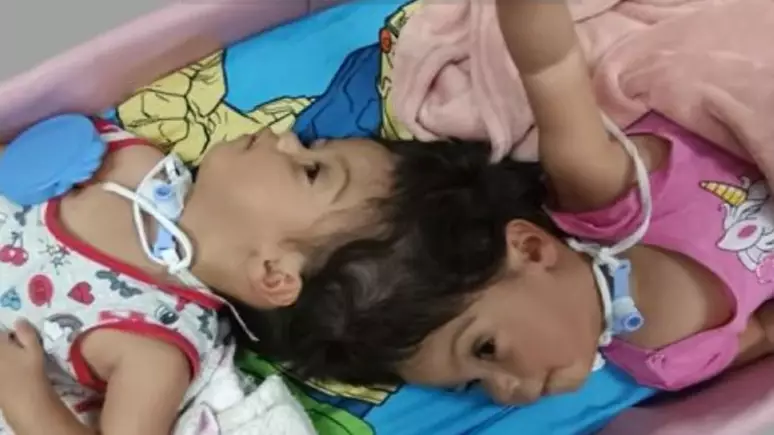 Irmãs gêmeas craniópagas que nasceram unidas pela cabeça morrem em SP